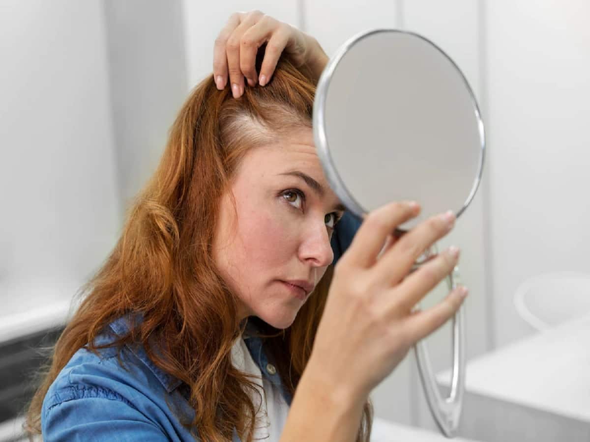 Alopecia: Psychosocial Impact of Hair Loss Is Greater In Women Than Men, Finds Study